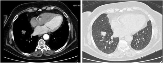 Nodule of 1.6 cm × 2 cm in the basal pyramid of the right lower lobe, far enough from both the apical segment and the lobar hilum ensuring an oncologically safe basal pyramid resection or lower lobectomy.