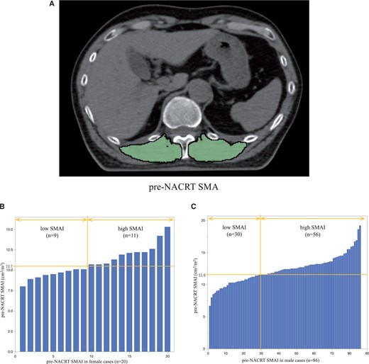 (A) Paravertebral muscle area at the 12th thoracic vertebra level before NACRT (example). Green highlights indicate the skeletal muscle area. (B) Histogram of SMAI in female patients. (C) Histogram of SMAI in male patients. NACRT: neoadjuvant chemoradiotherapy; SMAI: skeletal muscle area index.