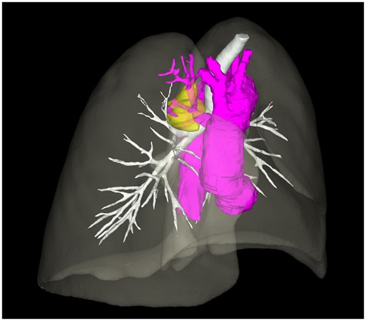 Three-dimensional reconstruction of the thorax shows the soft tissue mass (yellow), and the abnormal branching to sequestration arising from the ascending aorta (purple).