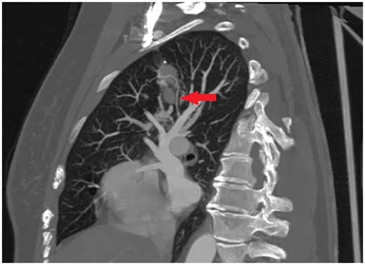 The venous drainage was mainly via the pulmonary veins.