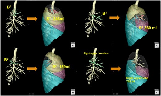 Actual method for segmental volumetry of the right upper lobe. First, bronchial bifurcation in the right upper lobe is identified. Subsequently, each target bronchus is selected, and the segmental volume is automatically calculated.