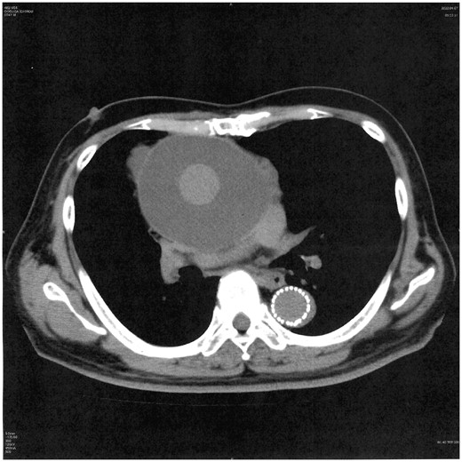 Enlarging perigraft seroma compressing the left pulmonary artery.