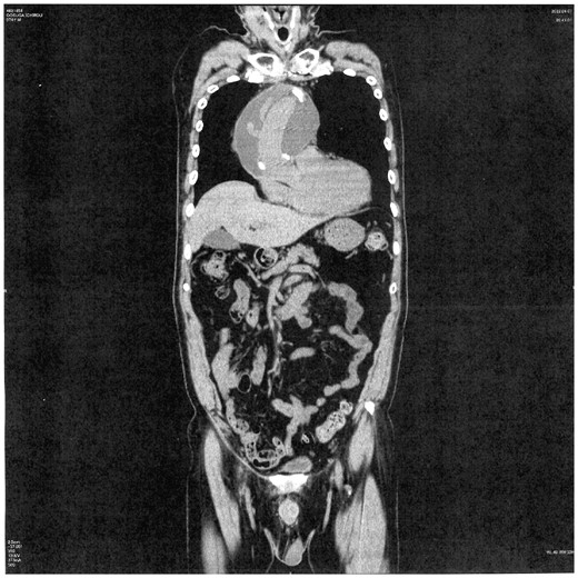 Perigraft seroma developed longitudinally from the bottom of the aortic root up to the aortic arch.