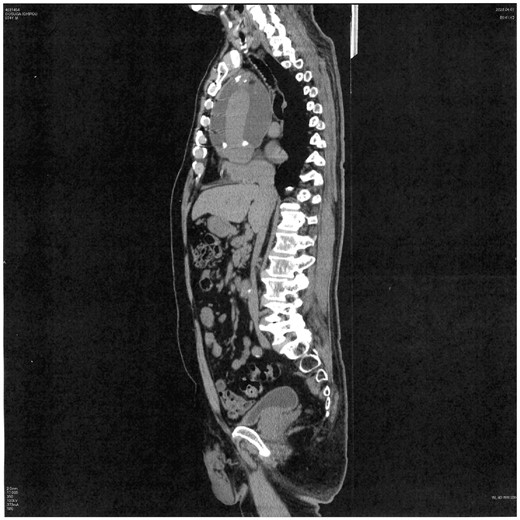 Large perigraft seroma attached to back of the sternum, creating a skin fistula.