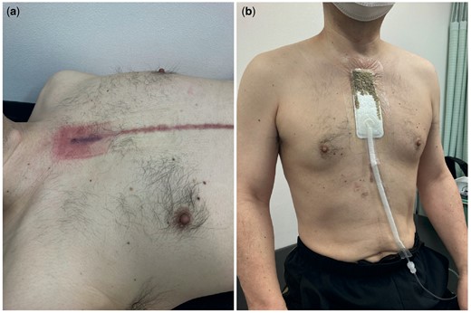 (a) Skin erosion due to fluid leakage through the perigraft seroma and skin fistula. (b) Wound-VAC system applied to the skin lesion to evacuate the fluid discharge.