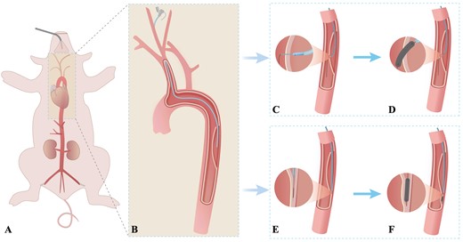 Schematic diagram of the endovascular reintervention-induced porcine type B aortic dissection model. (A and B) The right common carotid artery is exposed through a median neck incision under sterile conditions and cannulated with an 8-Fr Fustar Steerable sheath (Lifetech Scientific Inc., Shenzhen, China), which is deployed through the primary entry tear to the middle of the false lumen. (C and D) Procedure conducted in the secondary tear creation model. The fenestration in the flap is created by combining the adjustable puncture needle system and the Fustar Steerable sheath. Then, the secondary tear is dilated using different balloon diameters as needed. (E and F) Procedure conducted in the false lumen extension model. The tip of the support catheter and guide wire are carefully drilled into the subintima of the aortic wall using the guidewire in the loop formation. The space under the intima was sequentially enlarged using different balloons as needed.