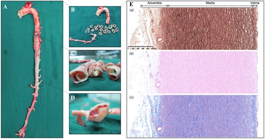 (A and B) On macroscopic examination, the false lumen is extended into the orifice of the superior mesenteric artery. (C) The created dissection is located in the media layer of the aorta. (D) A re-entry tear found distal to the false lumen. (E) Microscopic examination of the normal thoracic aorta, including Elastica van Gieson (a), haematoxylin and eosin (b) and Masson staining (c), demonstrating that the aortic wall comprises 3 layers: the intima, the media and the adventitia. The vasa vasorum in the aortic wall is distributed in the adventitia and the outer third of the media.
