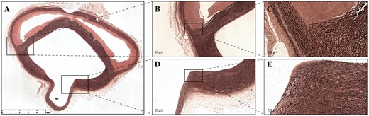 (A) Overview of the Elastica van Gieson staining of the aortic dissection at the branch of the intercostal artery (asterisk). (B) Microscopic examination of elastin staining showing the destruction of the elastic lamellar architecture in the media layer of the aortic wall. (C) Elastic fibres are much more stretched on the adventitial side of the false lumen than on the intimal side. (D and E) The elastic fibres on the intimal side gradually gather and terminate at the orifice of the aortic branch, while the elastic fibres on the adventitial side extend into the aortic branch.