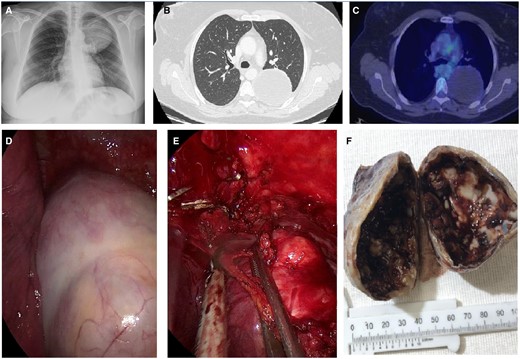 (A) Chest X-ray; (B) computed tomography; (C) FDG PET/CT; (D) tumour surface before surgical manipulation; (E) resection approach; and (F) tumour mass showing a cystic cavity partially covered with blood material.