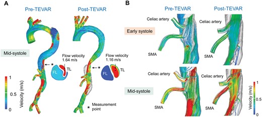 Streamline analysis. (A) Aorta at the mid-systole. (B) Visceral vessels at the early- and mid-systole. FL: false lumen; TEVAR: thoracic endovascular aortic repair; TL: true lumen.