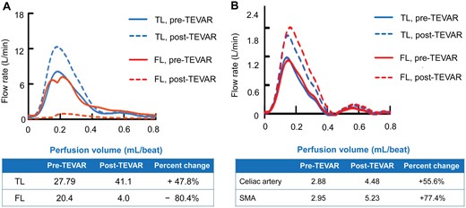 Line graph showing flow rate and perfusion volume before and after TEVAR. (A) TL and FL of the descending aorta. (B) Visceral vessels. FL: false lumen; TEVAR: thoracic endovascular aortic repair; TL: true lumen.