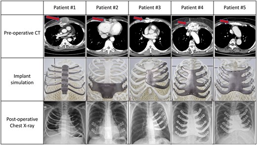 Preoperative findings, implant simulation, and postoperative chest X-ray of study participants.