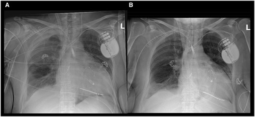 X-ray images. (A) Extracorporeal life support (ECLS) via right jugular vein and a single access for arterial return and Impella 5.5. (B) Impella 5.5 and temporary right-ventricular assist device (tRVAD) with a double-lumen cannula via the right jugular vein.
