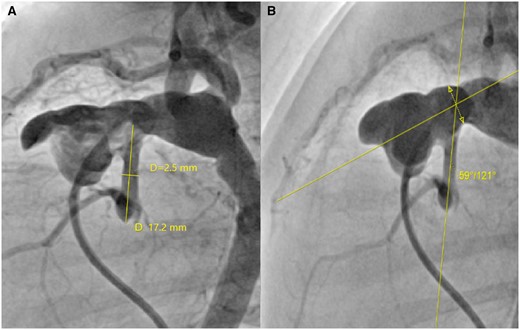 Measurement of aortic morphology in a preoperative angiogram, left lateral view, before stage II palliation (bidirectional cavopulmonary shunt): (A) Diameter and length of the native ascending aorta; (B) angle of the native ascending aorta–proximal pulmonary artery anastomosis. The interrupted line with the double arrow in the panel (B) represents the segment of the anastomosis between the pulmonary artery and the patch, through the centre of which the angle with the native ascending aorta is measured.