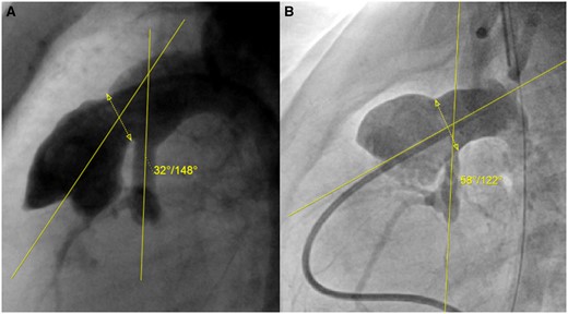 Various angles of native ascending aorta–proximal pulmonary artery anastomosis after the Norwood procedure: (A) Narrow angle (15th percentile); (B) large angle (86th percentile). The interrupted line with the double arrow represents the segment of the anastomosis between the proximal pulmonary artery and the patch, through the centre of which the angle with the native ascending aorta is measured.