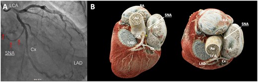 (A) Left coronary angiography: the sinus node artery (arrows) originates from the circumflex artery. (B) Coronary computed tomography angiography of the sinus node artery (yellow line and white arrows) originating from the proximal part of the circumflex artery and running over the left atrial roof towards the sinus node. Ao: aorta; Cx: circumflex artery; LA: left atrium; LAD: left anterior descending artery; LCA: left coronary artery; RA: right atrium; SNA: sinus node artery.