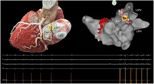 Three-dimensional volume rendered reconstruction of the coronary anatomy on cardiac computed tomography (left). The sinus node artery (small arrows) originates from the circumflex artery and courses underneath the left atrial appendage before ascending between the left atrial appendage and the left superior pulmonary vein towards the left atrial roof and cavo-atrial junction. Ablation in the superior part of this region (circle) repeatedly resulted in sinus arrest necessitating atrial pacing as shown on the electrocardiogram underneath the 3-dimensional images. LAA: left atrial appendage; LCA: left coronary artery; LSPV/LIPV: left superior/inferior pulmonary vein; RCx: circumflex artery.