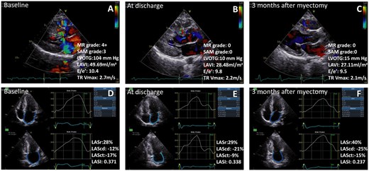 Treatment with transapical beating-heart septal myectomy led to significant decreased thickness of the interventricular septum, relieving the obstruction of the LVOT and MR grade, improved left atrial size and function, improve LV diastolic function during the short-term follow-up for hypertrophic obstructive cardiomyopathy patients. MR: mitral regurgitation; SAM: systolic anterior motion; LVOTG: left ventricular outflow tract grade; LAVI: left atrial maximum volume index; E/e′: early mitral inflow velocity/the average of septal and lateral mitral annular early diastolic velocity; TR Vmax: tricuspid regurgitation maximum velocity; LASr: left atrial reservoir strain; LAScd: left atrial conduit strain; LASct: left atrial contraction strain; LASI: left atrial stiffness index.