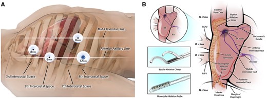 (A) Port setup: 8-mm ports were placed in the 3rd, 5th and 7th intercostal spaces with a 12-mm working port in the 8th intercostal space. (B) The lesion set was made using the Synergy bipolar ablation clamp and the monopolar EPi-Sense ST ablation probe.