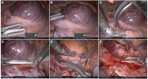 (A) Sinoatrial node was identified by mapping the earliest activation site and epicardially via right atrial tenting. (B) It was marked with a blue marker. (C) The SVC was isolated using the clamp. (D) Lesions anchoring the venae cavae were made with the ablation probe. (E) Small bites from SVC to mid-RA with the clamp ablated the crista terminalis. (F) Two mid-crista lesions were made with the clamp. RA: right atrium; SVC: superior vena cava.
