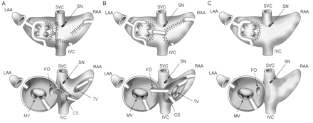 Three modifications of the maze procedure by using cryoablation in the present study: (A) Modified Cox-Maze III procedure; (B) Modified Kosakai-Maze procedure; and (C) Simple left atrial maze procedure. The upper panels show epicardial views and the lower panels, endocardial views of the cardiac base. The thick white dashed lines denote the cryoablation. The solid lines with crossbars represent incisions and sutures. LAA; left atrial appendage, RAA; right atrial appendage, SVC; superior vena cava, IVC; inferior vena cava, SN; sinus node, MV; mitral valve, FO; foramen ovale, TV; tricuspid valve, CS; coronary sinus.