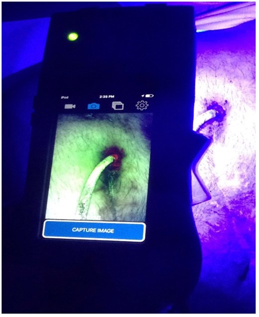 The Moleculight i:X in the outpatient setting. The fluorescence light around the entry side of the driveline is a sign for infection.