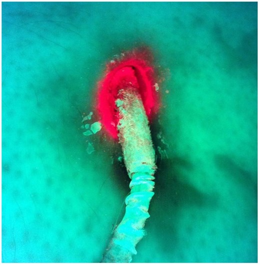 False-positive result. Microbiological examination found bacteria of the physiological flora only.