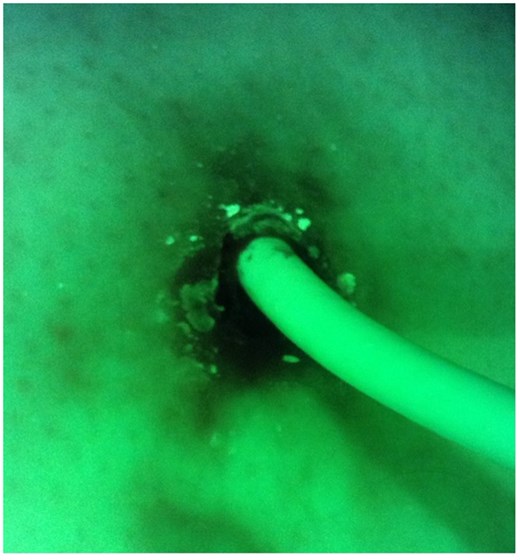 False-negative result. Microbiological examination confirmed colonization with Staphylococcus aureus.