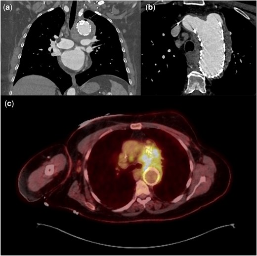 (a, b) CTA 2 months following TBE, demonstrating gas external to endograft with large pseudoaneurysm secondary to type 1a endoleak. (c) PET demonstrating significant FDG uptake at stented arch aneurysm. TBE: thoracic branched endograft