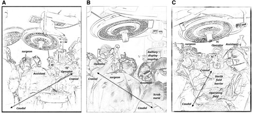 An illustrating sketch or the cardiac operating room showing ongoing real-time coronary thermal angiography in coronary bypass surgery. (A) View of from the left side of the operating table showcasing the position of the operating surgeon, assistant and the TC operator. (B) View from the right side of the operating table. (C) View from the foot of the operating room table. TC: thermal camera.