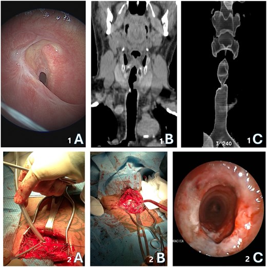 (1A) Endoscopic image of a severe subglottic tracheal stenosis; (1B) CT coronal view of the tracheal stenosis; (1C) 3D cervical reconstruction of upper airway area; (2A) intraoperative cross-field ventilation; (2B) intraoperative picture of tracheal anastomosis by single stiches; (2C) post-operative endoscopic check of trachea resection