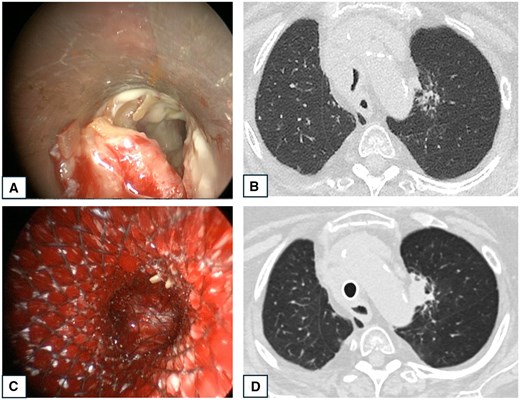 Operative images and CT-scan of a patient presenting tumoural infiltration of the lower third of the trachea. (A) Bronchoscopic image showing tumoural infiltration of the trachea. (B) Pre-operative CT-scan showing tracheal stenosis by a mediastinal mass. (C) Bronchoscopic image of a covered Y-shaped SEMS insertion. (D) CT-scan 2 days postoperative showing the Y-shaped stent in place with restored tracheal lumen.