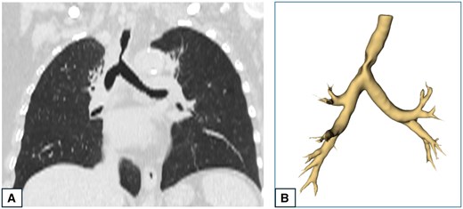CT-scan and 3D reconstruction of a patient presenting tumoural infiltration of the lower third of the trachea. (A) CT-scan showing a stenosis in the lower third of the trachea. (B) 3D reconstruction of the tracheo-bronchial three showing the tracheal stenosis.