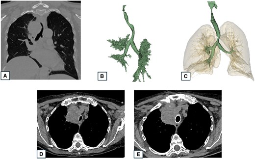 CT-scan images and 3D reconstruction of a patient presenting tracheal infiltration and deviation by a thyroid tumour. (A) Preoperative CT-view showing tracheal stenosis and deviation; (B) Preoperative 3D reconstruction showing tracheal stenosis and deviation; (C) Postoperative 3D reconstruction showing tracheal stent and lung in transparency; (D) Preoperative CT showing tracheal stenosis and tumour compression; and (E) Postoperative CT-scan showing the cylindric tracheal stent restoring airway patency.