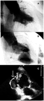 A. One year follow-up LVG revealed only a small concavity in the inferior wall. B. A huge left ventricle pseudoaneurysm formed within a month after follow-up LVG. C. We detected recurrence of LV aneurysm by an echocardiogram at first.