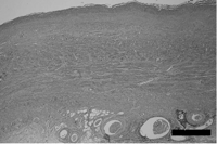Micrograph of the wall of aneurysm. Elastica van Gieson stain was performed. The wall consisted of elastic collagen fiber. Bar=5 mm.