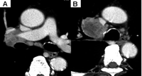 Preoperative CT images of tumor invasion to PA (A), SVC and right main bronchus (B).