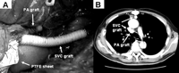 Prosthetic replacements of SVC and PA (A), and CT image indicating good triple graft patency three years after operation (B).[ql