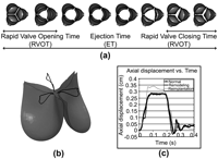 Representation of the phases of leaflet dynamics over the cardiac cycle (a), diagram of tracked directions for displacements and velocities (b), and plot of axial displacements of the leaflet tip over time (c).