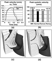 Plot of peak velocity over the cardiac cycle for a sample MRI-derived data set and normal valve model (a), comparison of maximal systolic velocities for MRI data set and computational models (b) and vortex and blunt velocity profile in remodeling (c) and reimplantation (d) cases, respectively.