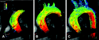 Time-resolved 3D particle-trace visualization of blood flow at three time points in the systole of a healthy individual without alterations of the aortic geometry. Laminar-like flow distribution over the aortic arch, in the supraaortic branches and the descending aorta can be appreciated. No evolvement of vortices, roll-like flow formations or retrograde flow are visible.