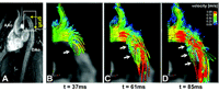 A. Contrast-enhanced MR-angiography covering the ascending (AAo) and descending (DAo) thoracic aorta in a patient with implanted prosthesis for repair of the proximal descending aorta after traumatic rupture with clear delineation of the implanted prosthesis (yellow arrow). The white rectangle indicates the magnified area in B-D for which time-resolved 3D particle trace visualization was performed. B-C. Systolic blood flow patterns visualized as time-resolved particle-traces in three successive time frames. Complex blood flow and a marked helix formation (white arrows) within the graft are clearly visible. Color coding corresponds to the measured local velocities. The 3-dimensional temporal evolution of blood flow can be most clearly appreciated in the supplementary movie file.