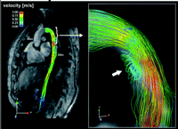 Systolic blood flow visualized as stream-lines provide an overview over blood flow velocities and hemodynamic alterations including the vortex formation (white arrow) at the small curvature in the proximal descending aorta. Color coding corresponds to the local velocity magnitude.