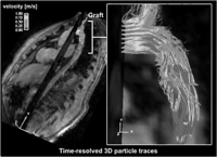 3D particle trace visualization of the hemodynamic alterations in a patient with a Dacron graft repair after traumatic rupture of the proximal descending aorta. On the left an overview is given. On the right, massive turbulences and flow acceleration can be appreciated. Measured flow velocities are color-coded. A roll-like tubular turbulence at the inner curvature can be seen as shown in Fig. 3.