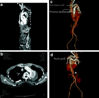 Preoperative CT: (a) Sagittal view: the dissection arising from the distal end of the previous replaced graft. (b) Axial view: dissection flap involving the entire arch with the largest diameter exceeding 6 cm. Post-operative 3-D CT reconstruction: (c) anterior view of CT with 3-D reconstruction seven days after repair (d) post view. *Communicating hole just below the celiac artery level.