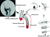 Depiction of hybrid surgical procedure: after reverse sleeve graft was prepared as in Fig. a, the entire arch is replaced with distal elephant trunk technique Fig. b, and complete angiogram after stent graft deployment is shown in Fig. c. ▾, anastomosis site of reverse sleeve graft; LSA, left subclavian artery.