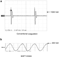 (a) Wave form of conventional coagulation: pulse-modulated sinusoidal alternating voltage Max. peak voltage: >1,000 Vp, (b) Wave form of SOFT COAG: unmodulated sinusoidal alternating voltage Max. peak voltage: <200 Vp.