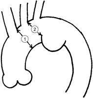 Schema of distal aortic arch aneurysm. The indication of thoracic endovascular aortic repair is that a diameter of a proximal landing zone is <37 mm and that a proximal end of the diseased aortic segment is >15 mm away from the left common carotid artery .