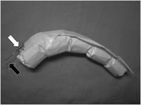 A hand-made fenestrated stent graft. A proximal roof of a stent graft is fenestrated (white arrow) to preserve head vessels. A wire ring (black arrow) prevents distal migration of the device during stent-graft deployment. In a case of aortic dissection, a stent graft is often tapered to fit a size of a true lumen. A stent graft is custom-made to fit the distal aortic arch.