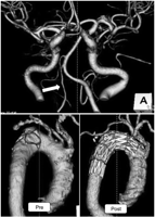 Computed tomographic angiography (CTA) images. CTA of the vertebro-basilar artery revealed hypoplastic right vertebral artery (white arrow) (upper). A fenestrated stent graft well preserved antegrade blood flow into the left subclavian artery as well as the left common carotid artery (lower).